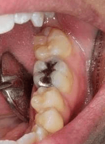 Before & After Photos, Cracked Tooth Repair Gallery