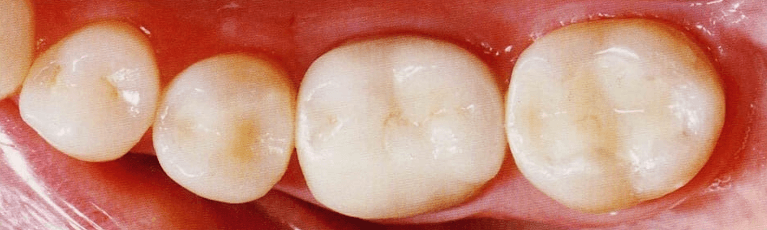 Composite-Fillings-After-Image
