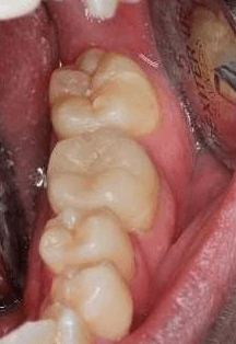 Cracked-Tooth-Repair-After-Image