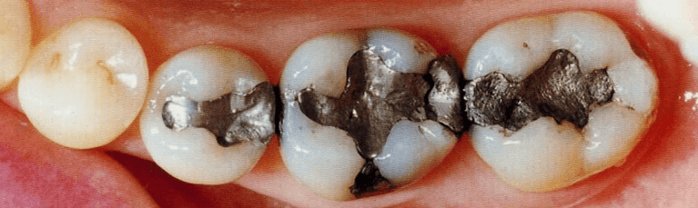 Composite-Fillings-Before-Image